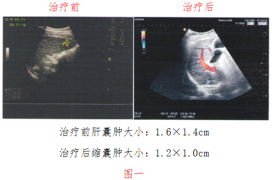 胃癌（低分化型）