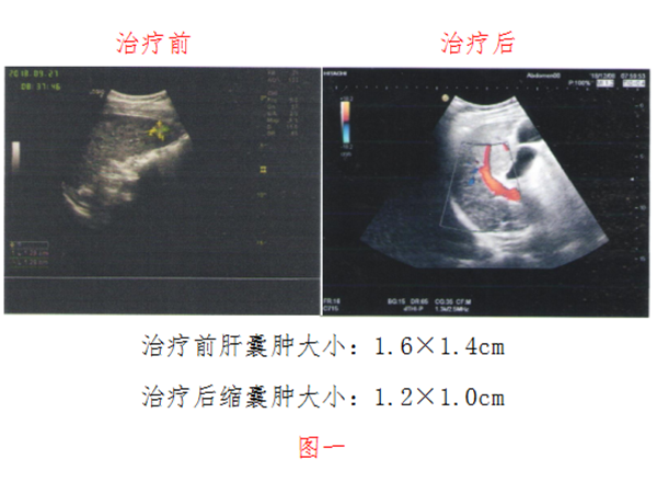 胃癌（低分化型）