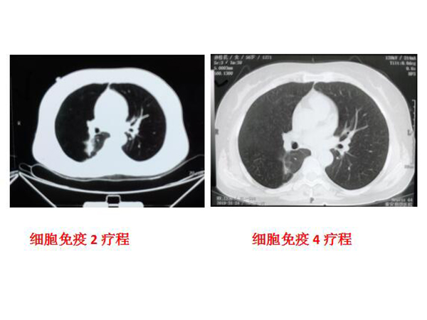 右肺腺癌，胸骨、左手无名指骨转移